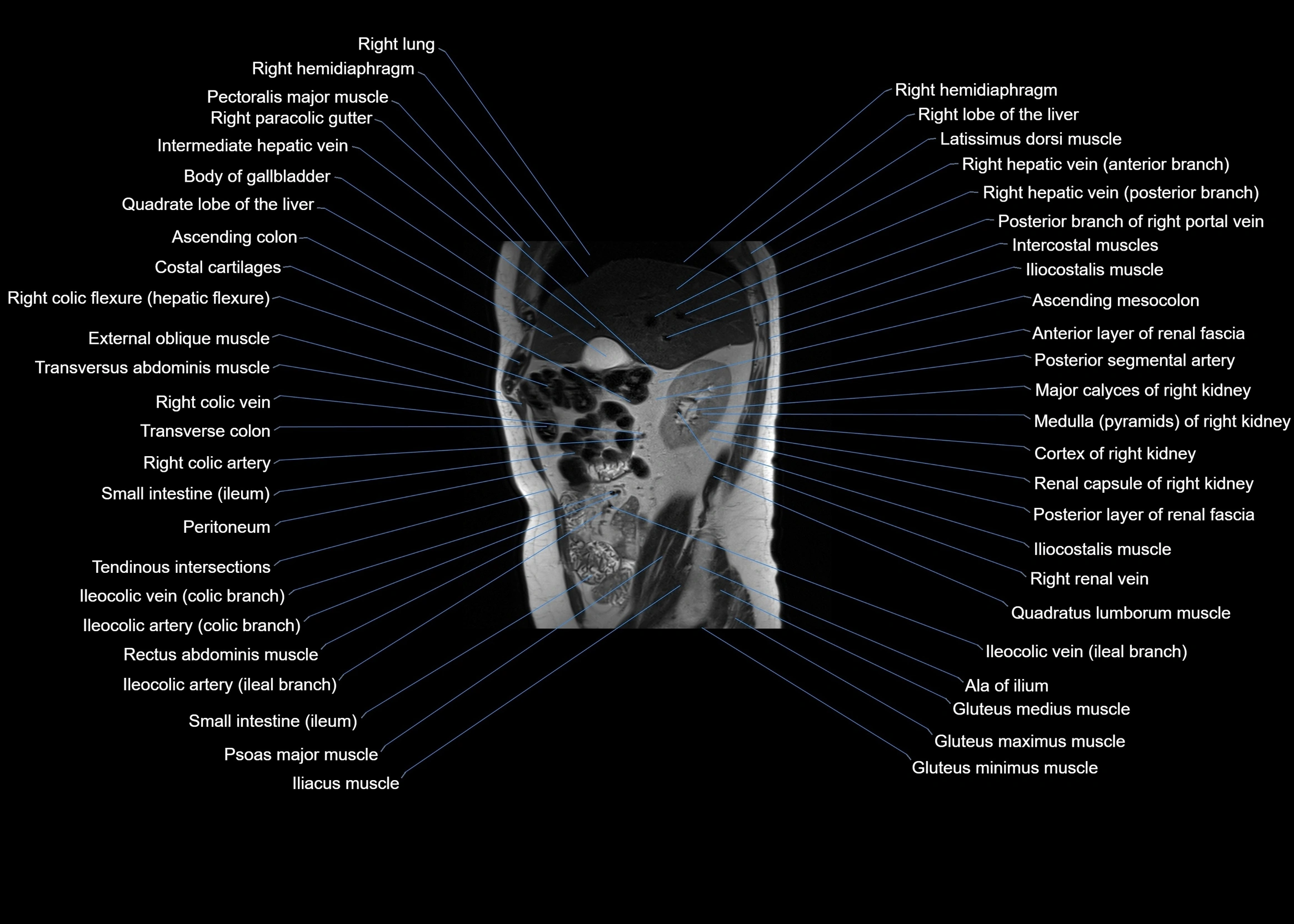 MRI abdomen sagittal cross sectional anatomy  radiology  image-img-00001-00024.webp